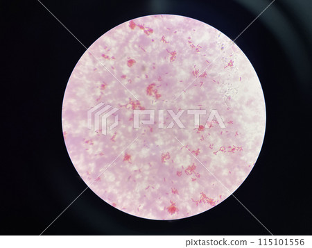 Moderate gram negtive bacilli in hemoculture. Moderate gram negtive bacilli in hemoculture. 115101556