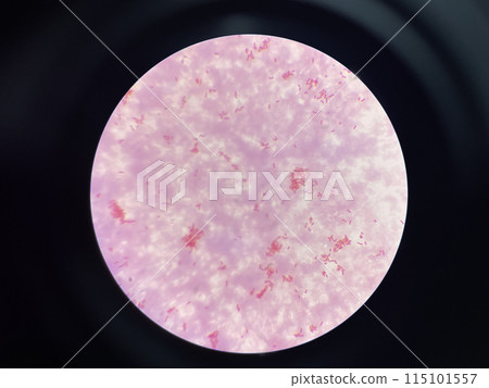 Moderate gram negtive bacilli in hemoculture. Moderate gram negtive bacilli in hemoculture. 115101557