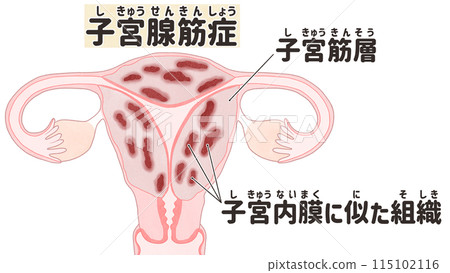 Adenomyosis: Easy-to-understand Japanese illustrations 115102116