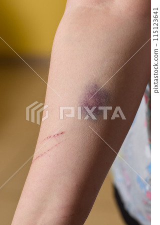 A closeup of a bruised arm with a temporary tattoo A closeup of a bruised arm with a temporary tattoo 115123641