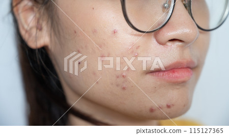 Close up of worried Asian woman having acne inflamed on her face. Inflamed acne consists of swelling, redness, and pores that are deeply clogged with bacteria, oil, and dead skin cells. 115127365