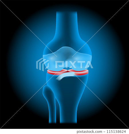Knee meniscus injuries. knee joint anatomy Knee meniscus injuries. knee joint anatomy 115138624