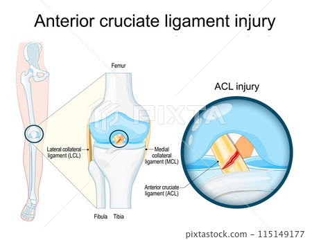 Anterior cruciate ligament injury. Close-up of a human knee joint 115149177