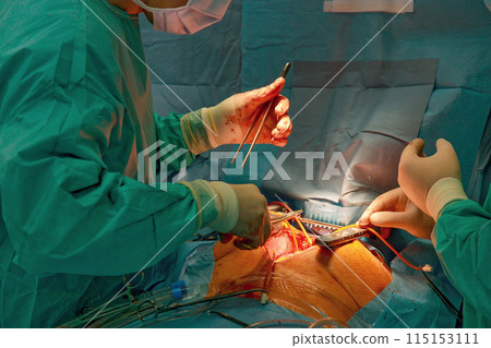 During heart surgery, team of physicians performs procedure in an operating room During heart surgery, team of physicians performs procedure in an operating room 115153111