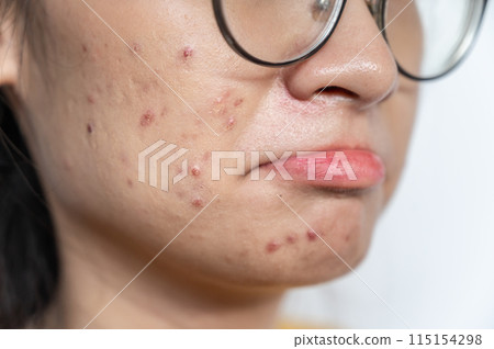 Close up of worried Asian woman having acne inflamed on her face. Inflamed acne consists of swelling, redness, and pores that are deeply clogged with bacteria, oil, and dead skin cells. 115154298