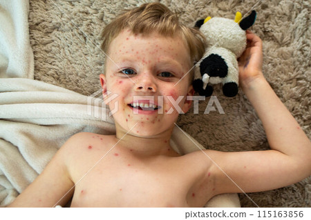 Natural vaccination. Contagious disease. Natural vaccination. Contagious disease. 115163856