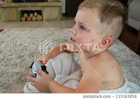 Natural vaccination. Contagious disease. Natural vaccination. Contagious disease. 115163858