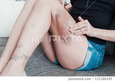 A young woman smears a large bruise on her thigh with ointment A young woman smears a large bruise on her thigh with ointment 115166185