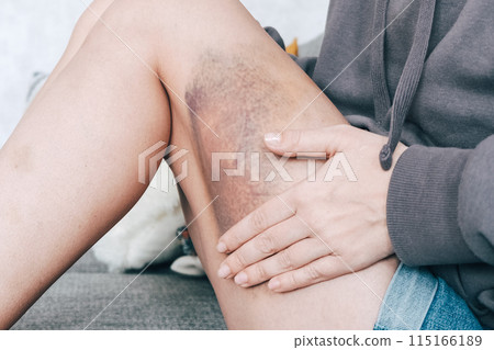 A young woman smears a large bruise on her thigh with ointment 115166189