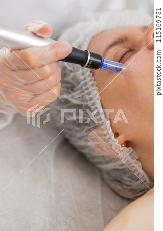 Cosmetologist doing peeling procedure, woman skin regeneration, dermapen microneedling, dermastamp Cosmetologist doing peeling procedure, woman skin regeneration, dermapen microneedling, dermastamp 115169781