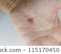 fly insect bite on hand. skin infection allergy 115170450