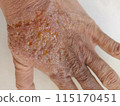rash eczema dermatitis  on finger hand. inflammation of skin 115170451