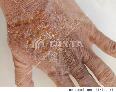rash eczema dermatitis  on finger hand. inflammation of skin 115170451