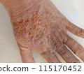 rash eczema dermatitis  on finger hand. inflammation of skin 115170452