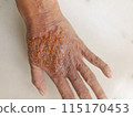 rash eczema dermatitis  on finger hand. inflammation of skin 115170453