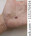 fly insect bite on hand. skin infection allergy 115170454