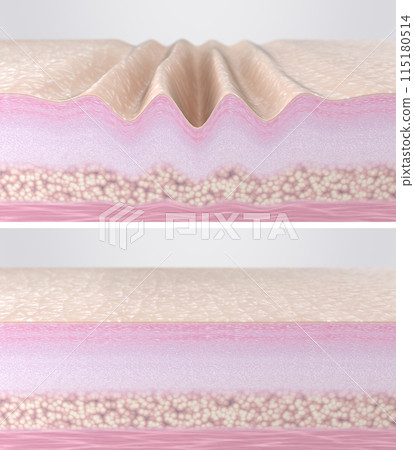 Wrinkled aged and young smooth skin comparison. 3d rendered illustration. Cross-section of skin tissues before and after hyaluronic acid injections, collagen peptides, laser therapy, EMS, RF facelift Wrinkled aged and young smooth skin comparison. 3d rendered illustration. Cross-section of skin tissues before and after hyaluronic acid injections, collagen peptides, laser therapy, EMS, RF facelift 115180514