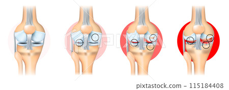 Stages of knee joint osteoarthritis - Stock Illustration [115184408 ...
