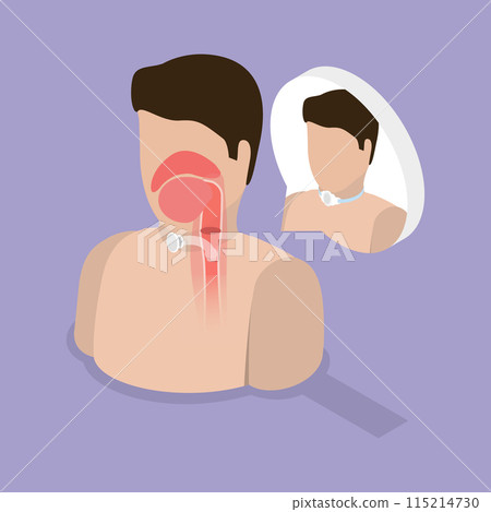 3D Isometric Flat Vector Illustration of Tracheostomy, Tracheal Surgery 115214730