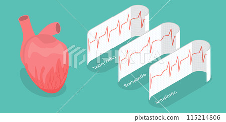 3D Isometric Flat Vector Illustration of Pathological Heart Rhythm Types, Electro-cardiogram 115214806