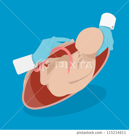 3D Isometric Flat Vector Illustration of Cesarean Section, Medical Surgery and Abdominal Incision 115214811