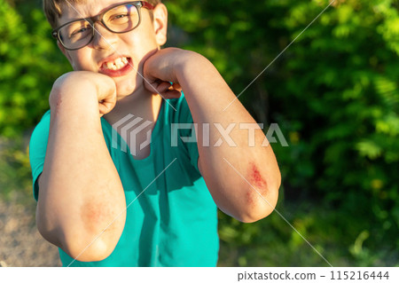 A young boy with a broken elbow, showing a bloody wound on his arm 115216444