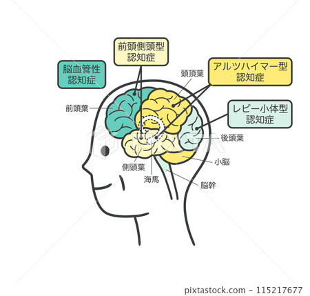 老年人因癡呆而受損的大腦部位圖解及其名稱 老年人因癡呆而受損的大腦部位圖解及其名稱 115217677