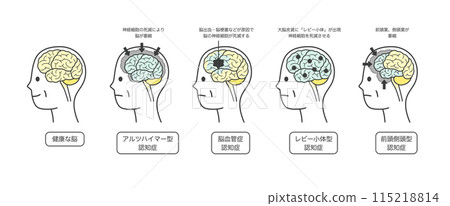 A set of illustrations of parts of the brain and their names that are damaged by dementia in the elderly 115218814