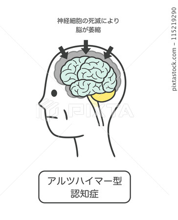 一組因阿茲海默症而受損的大腦部位及其名稱的插圖 115219290