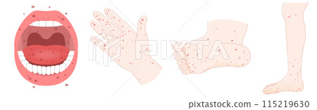 舌頭、牙齒、手、腳，手足口病圖解 115219630