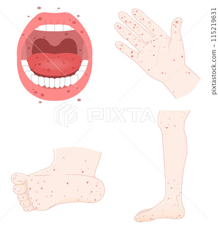 Tongue, teeth, hands, feet, hand, foot and mouth disease illustration, illustration Tongue, teeth, hands, feet, hand, foot and mouth disease illustration, illustration 115219631