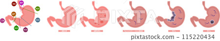 Set illustrations of stomach cancer 115220434