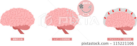 Brain dementia set 115221106