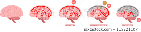 Brain stroke set 115221107