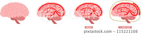 Brain cerebral hemorrhage set 115221108