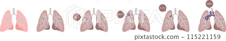 Lung cancer illustration set 115221159