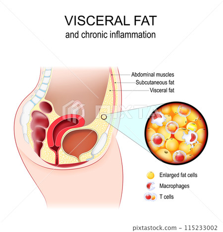 Visceral fat and Chronic inflammation Visceral fat and Chronic inflammation 115233002