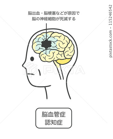 Illustration of the parts of the brain that are damaged by vascular dementia and their names Illustration of the parts of the brain that are damaged by vascular dementia and their names 115246542