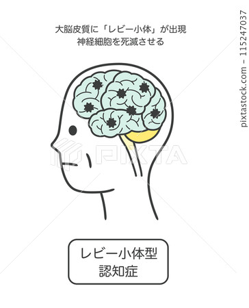 路易氏體失智症受損的腦部部位圖解及其名稱 115247037