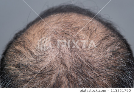 Cropped shot view of bald spot on Asian men's head with thin hair and white hair appear. Conceptual of hair problem on men's head. 115251790
