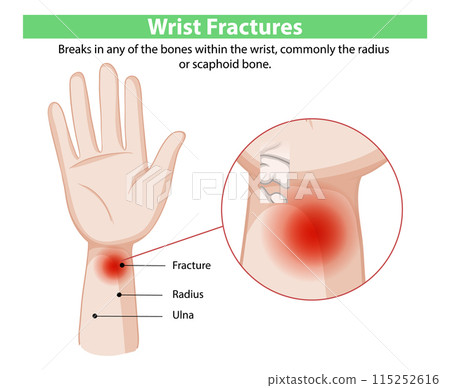 Wrist Fractures Illustration 115252616
