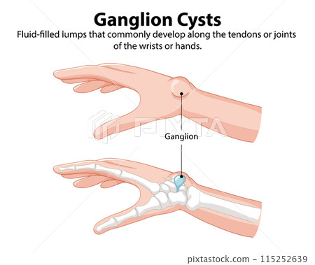 Understanding Ganglion Cysts in Hands Understanding Ganglion Cysts in Hands 115252639