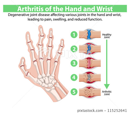 Arthritis of the Hand and Wrist Arthritis of the Hand and Wrist 115252641