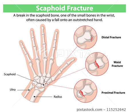 Scaphoid Fracture Diagram Scaphoid Fracture Diagram 115252642