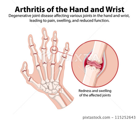 Arthritis of the Hand and Wrist Arthritis of the Hand and Wrist 115252643