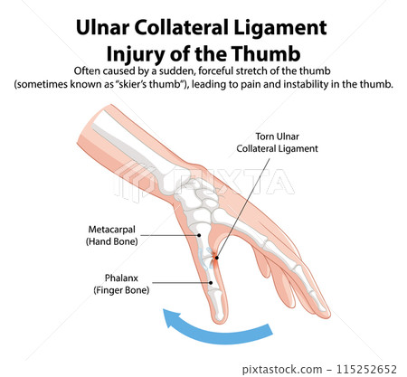 Ulnar Collateral Ligament Thumb Injury 115252652