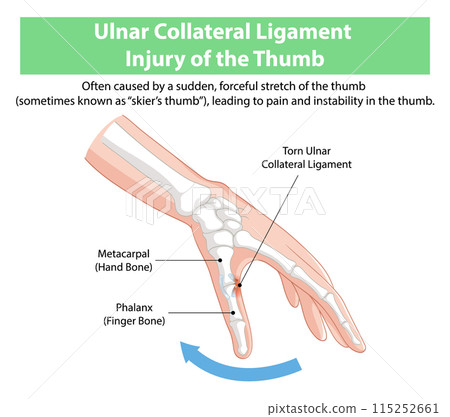 Ulnar Collateral Ligament Injury Illustration Ulnar Collateral Ligament Injury Illustration 115252661
