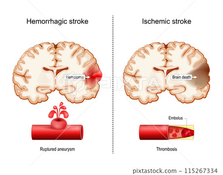 Hemorrhagic and Ischemic strokes. 115267334