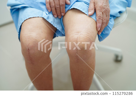 Asian elderly woman patient show her scars surgical total knee joint replacement Suture wound surgery arthroplasty. Asian elderly woman patient show her scars surgical total knee joint replacement Suture wound surgery arthroplasty. 115270286