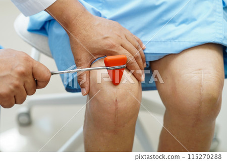 Doctor neurologist testing reflex knee with hammer and show Asian senior scars surgical total knee joint replacement. 115270288